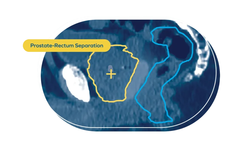 Prostate-Rectum Separation
