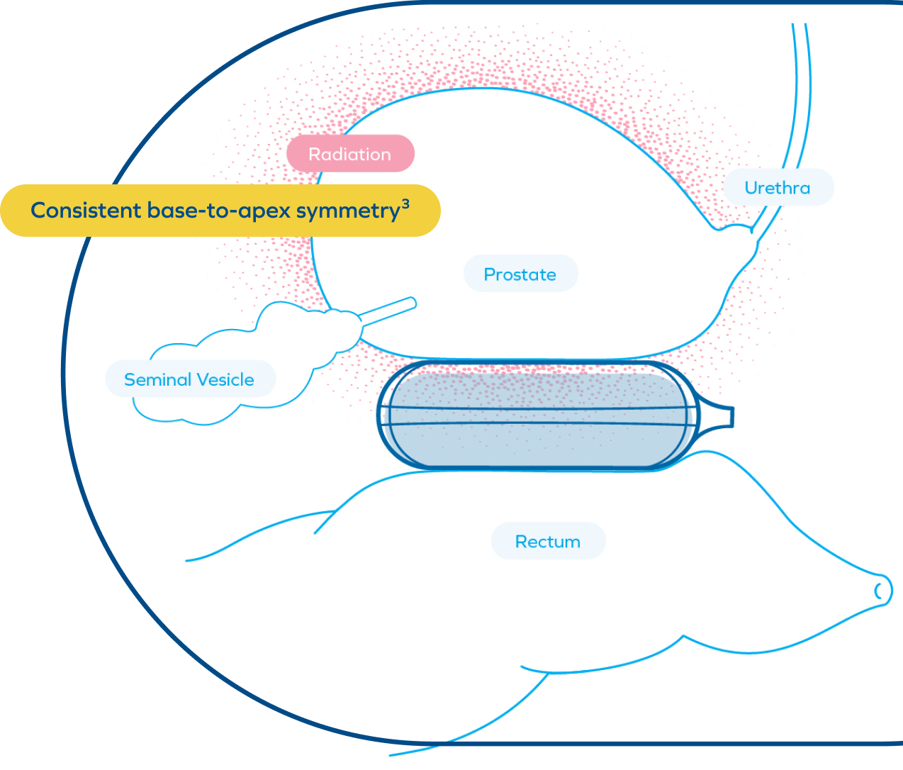 14 mm mean apical separation