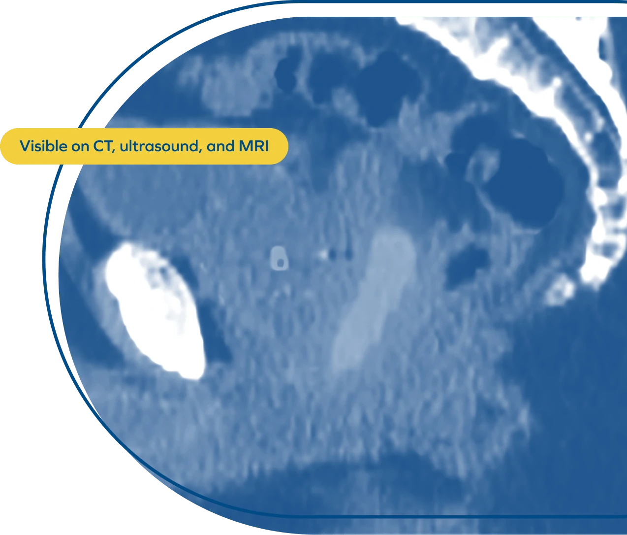 Visible on CT, ultrasound, and MRI