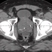 143 cc prostate post-CT showing BioProtect Balloon Spacer, prostate, and rectum.