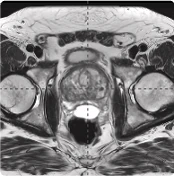 143 cc prostate post-MRI showing BioProtect Balloon Spacer, prostate, and rectum.