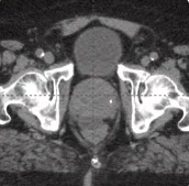 215 cc prostate post-CT showing BioProtect Balloon Spacer, prostate, and rectum.