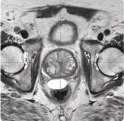 161 cc prostate post-MRI showing BioProtect Balloon Spacer, prostate, and rectum.