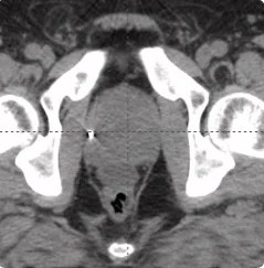 169cc prostate post-CT showing BioProtect Balloon Spacer, prostate, and rectum.