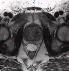169 cc prostate post-MRI showing BioProtect Balloon Spacer, prostate, and rectum.
