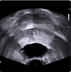 169 cc prostate ultrasound axial view showing BioProtect Balloon Spacer, prostate, and rectum.