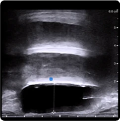 169 cc prostate ultrasound saggital view showing BioProtect Balloon Spacer, prostate, and rectum.