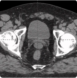 20 cc prostate post-CT showing BioProtect Balloon Spacer, prostate, and rectum.