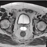 20 cc prostate post-MRI showing BioProtect Balloon Spacer, prostate, and rectum.