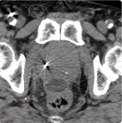 215 cc prostate post-CT showing BioProtect Balloon Spacer, prostate, and rectum.
