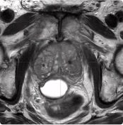 215 cc Prostate Post-MRI showing BioProtect Balloon Spacer, prostate, and rectum.