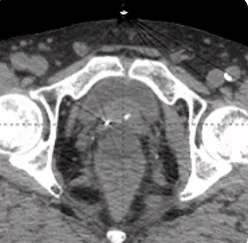 25 cc prostate post-CT showing BioProtect Balloon Spacer, prostate, and rectum. Patient received prior ADT.