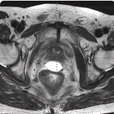 25 cc prostate post-MRI showing BioProtect Balloon Spacer, prostate, and rectum. Patient received prior ADT.