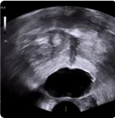 Axial view of BioProtect Balloon Spacer from physician one.