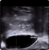 Saggital view of BioProtect Balloon Spacer from physician one.