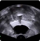 Axial view of BioProtect Balloon Spacer from physician two.