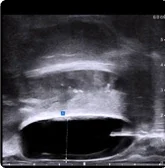 Saggital view of BioProtect Balloon Spacer from physician two.
