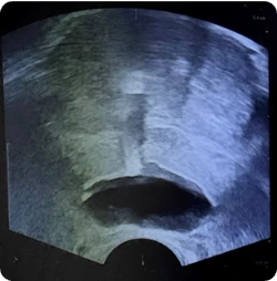 Axial view of BioProtect Balloon Spacer from physician three.