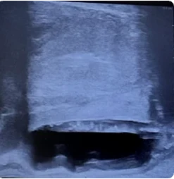 Saggital view of BioProtect BalloonSpacer from physician three.