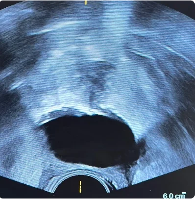 Procedural scan showing placement of the BioProtect Balloon Spacer in a salvage case. Axial view.