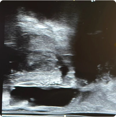 Procedural scan showing placement of the BioProtect Balloon Spacer in a salvage case. Saggital view.