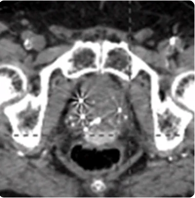 Procedural scan showing placement of the BioProtect Balloon Spacer in a salvage case. CT scan.