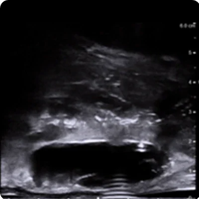Procedural scan showing placement of the BioProtect Balloon Spacer in a salvage case. Saggital view.